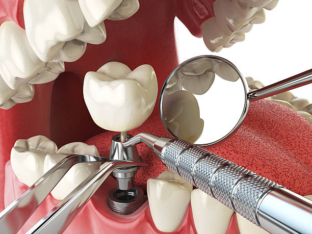 Best Emergency Root Canal Treatment in Jefferson, IA
